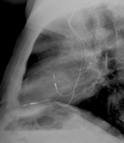 Single vs double chamber pacemaker